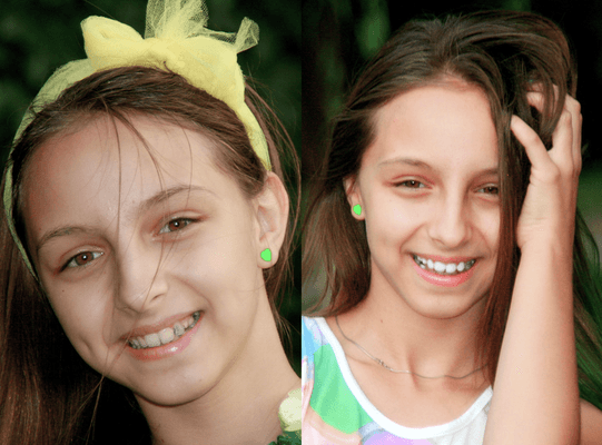 Комплексна чистка зубів і фторування 