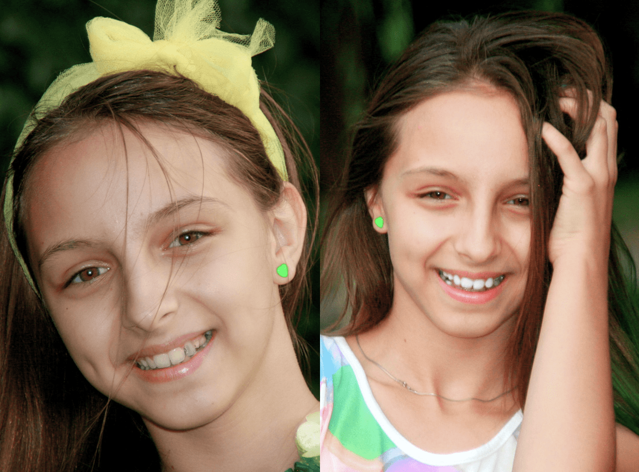 Комплексна чистка зубів і фторування 