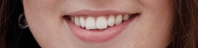 Реставрація зуба 3