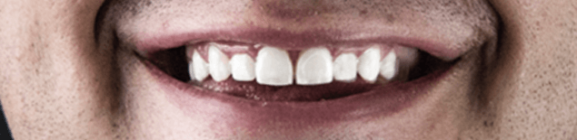 Професійна чистка і вініри 3