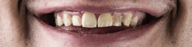 Професійна чистка і вініри 2